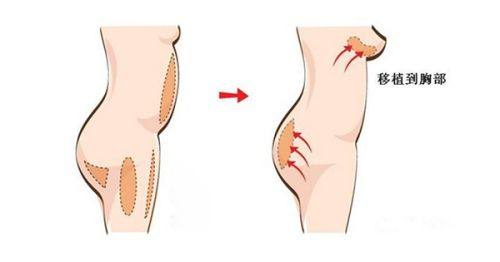 四、疤痕疙瘩打针能完全平掉吗