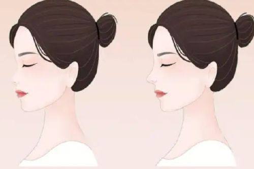 二、凹陷性面部疤痕：分层修复，填补皮肤缺损