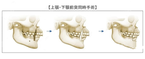 三、自体脂肪隆胸多久可以二次填充玻尿酸