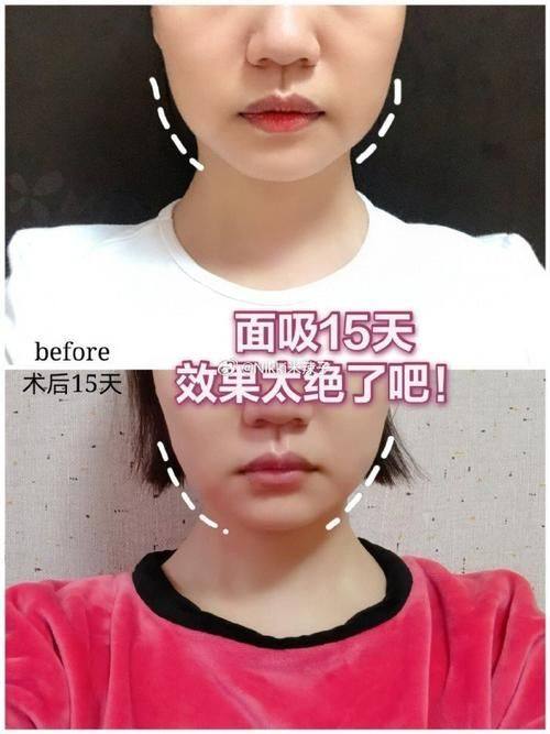 长沙瑞美整形医院怎么样？