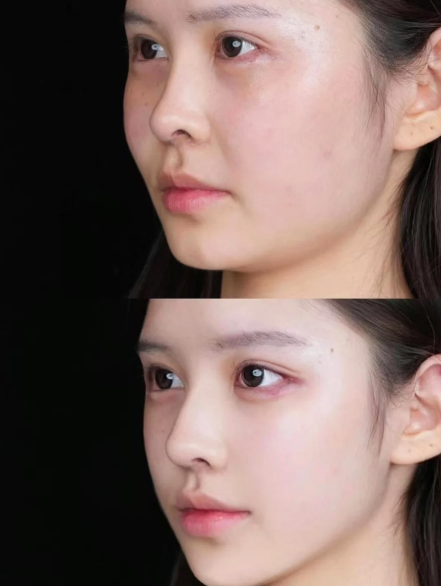 三、腹部吸脂的远期健康影响与网传误区