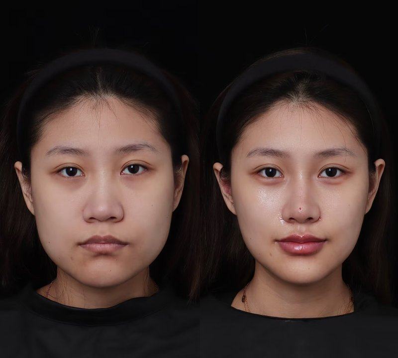 四、色素沉着/浅表型面部疤痕：淡化色素，还原皮肤质感