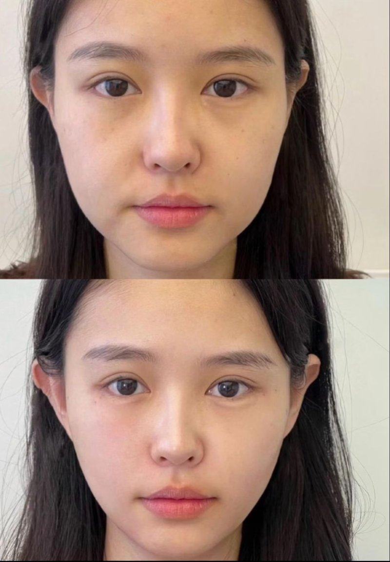 四、疤痕增生起泡的就医指征要记牢