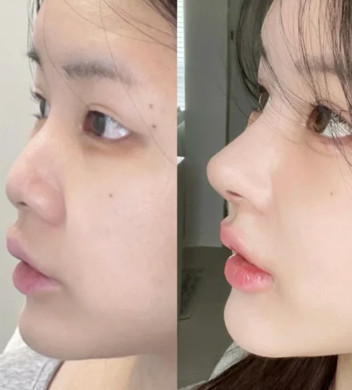 四、腹部吸脂的形态与感官类风险细节