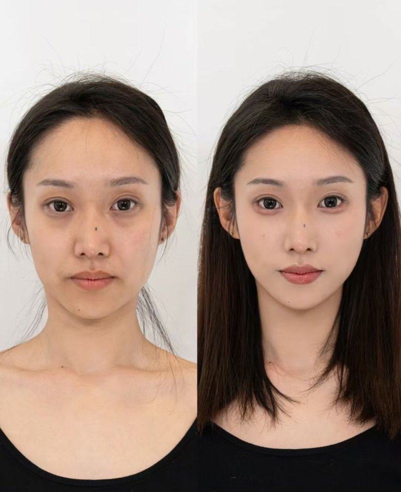 五、自体脂肪隆胸后多久可以做假体隆胸