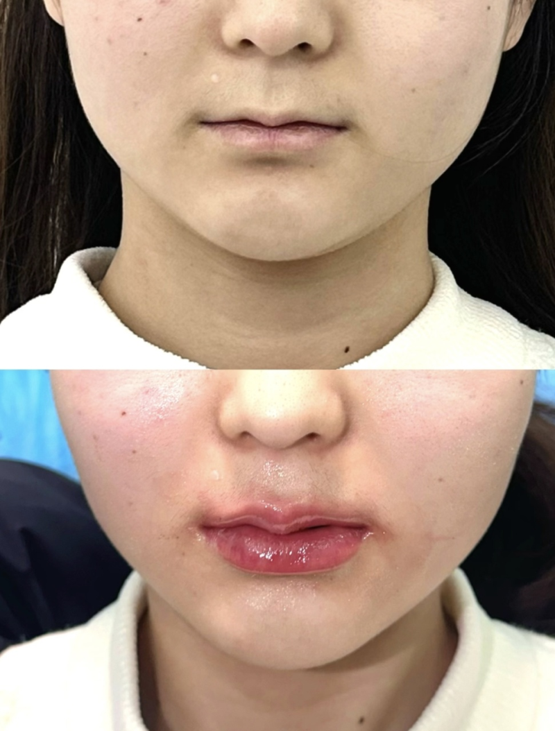 四、抽脂后运动减肥，要选对时机和方式