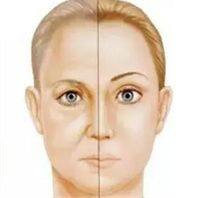 三、不开刀去眼袋能保持多长时间?会不会反弹?