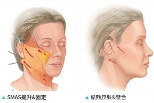 二、不开刀去眼袋成效到底怎么样?临床实例来验证