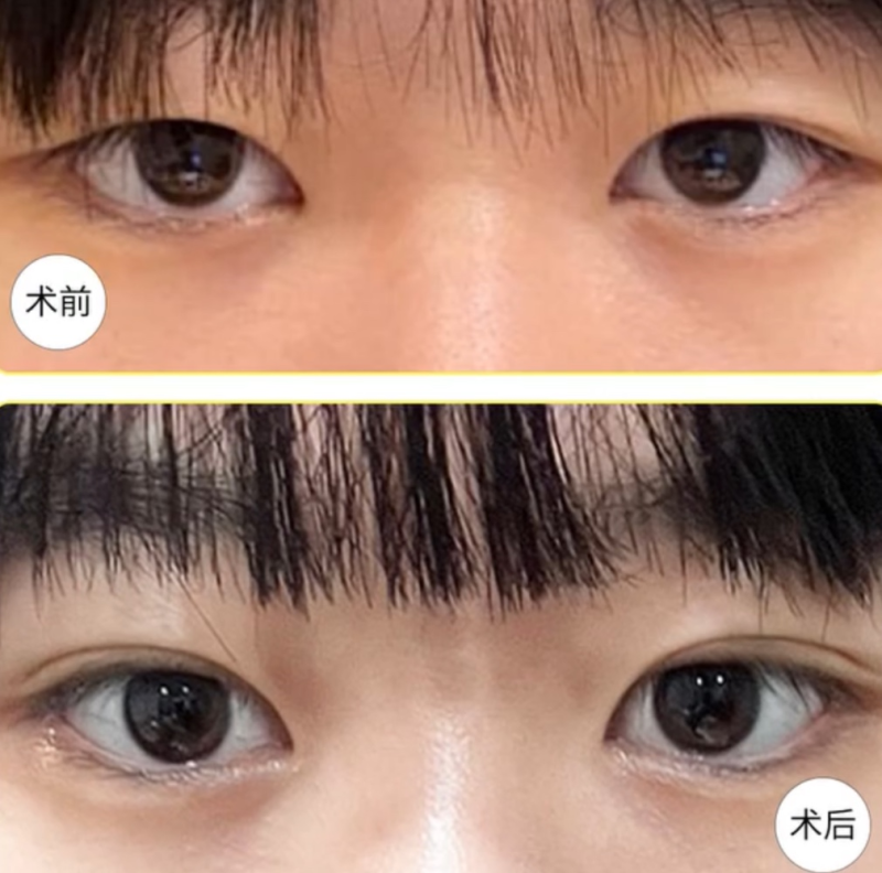 六、医生更推荐的祛痣方式：激光与手术