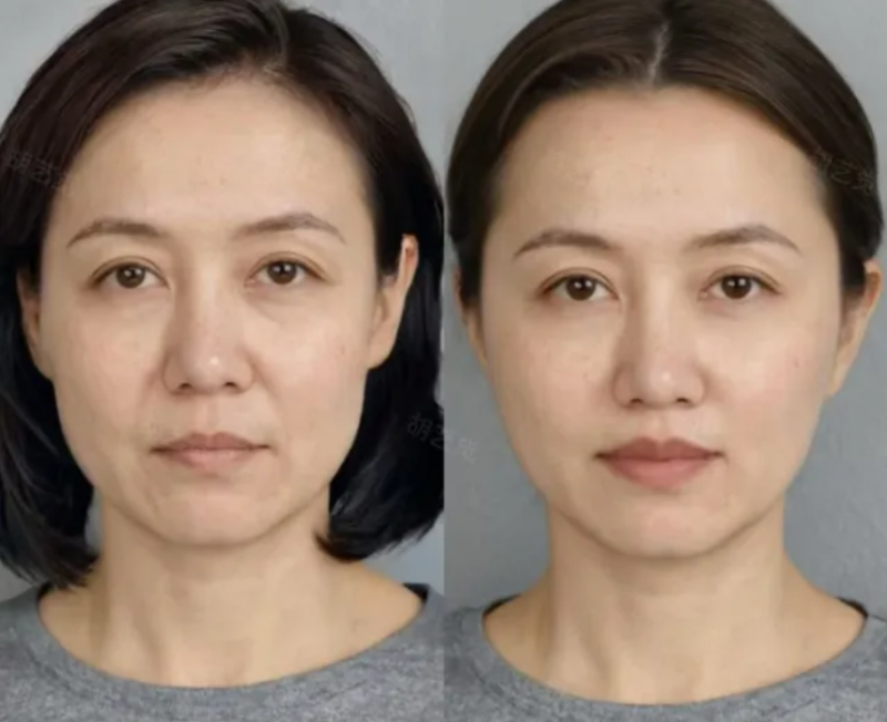 三、脂肪隆胸后可以减肥吗?减肥会让胸部变小吗?