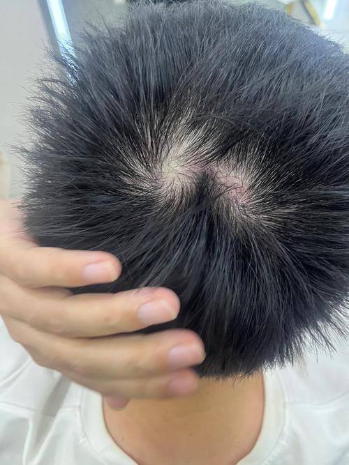 武汉洪山真程植发医院预约挂号方式