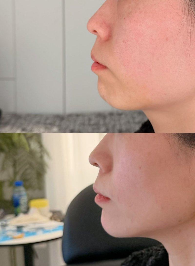 三、割眼袋“基本自然”与“深层稳定”的核心区别