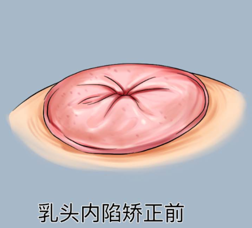 四、术后防疤护理核心要点