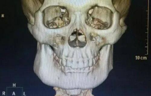 五、肋骨隆鼻修复阶段的通用护理要点