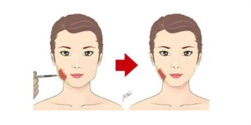 二、非正规抽脂的高风险伤害