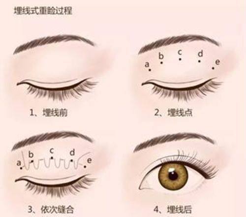 四、抽脂的安心前提与风险规避要点