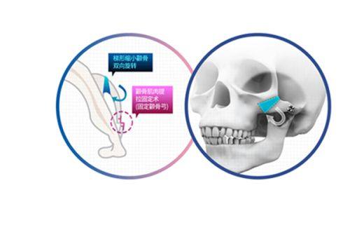 四、肋骨隆鼻后多久可以汗蒸、蒸桑拿