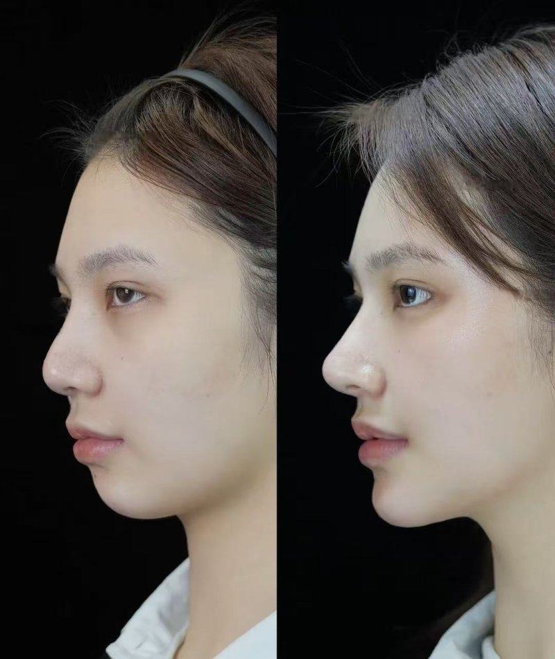 五、眼袋上面长了小肉球是什么原因