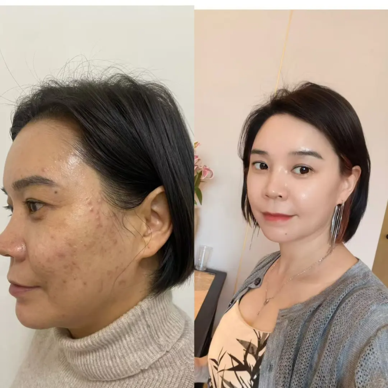 三、做完肋骨鼻多久能泡澡