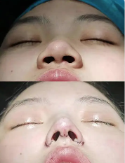 五、遗传眼袋怎么去除更有成效