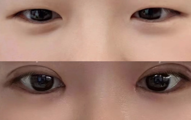 四、眼袋上面长了个包是怎么回事