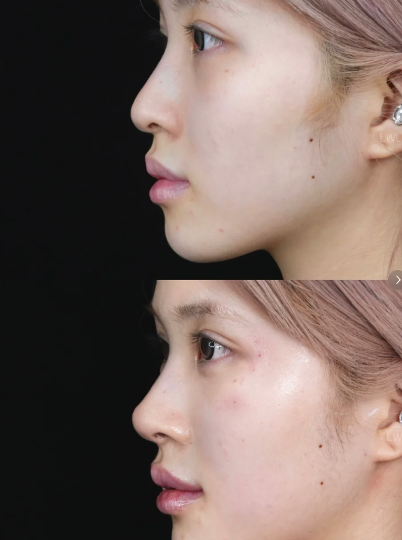 四、遗传眼袋大怎么办如何解决快又好