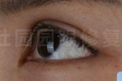 二、轻度/初期眼袋：日常保守改善方案