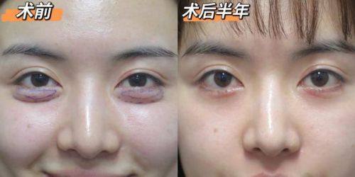 四、拆线前后的护理要点