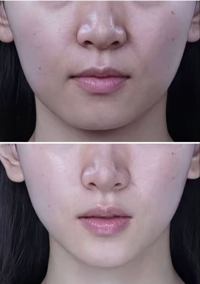 国内疤痕植眉的收费参考