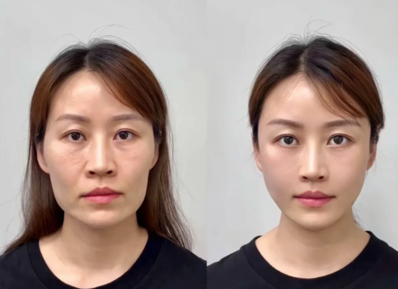 疤痕植眉的技术细节与注意要点