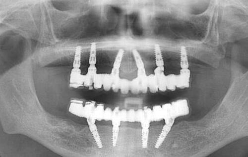 四、腰部吸脂的费用大概是多少