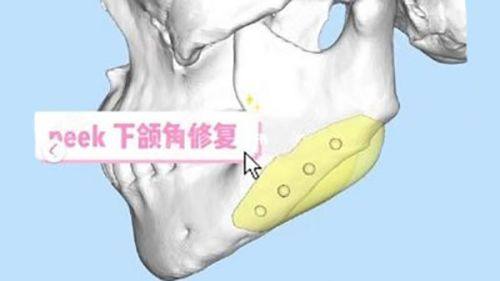 四、避开祛眼袋常见误区，别让努力白费