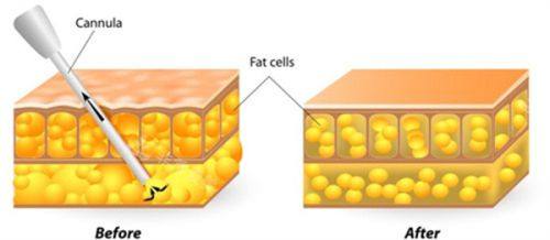 四、祛眼袋技术哪种更好?适配各类眼袋的选择指南