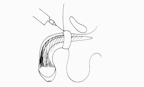 二、手术类祛眼袋详解