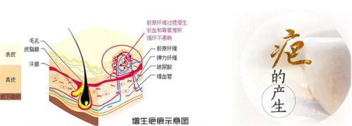 四、自体脂肪隆胸的副作用与后遗症