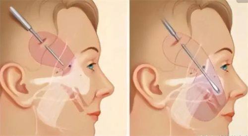 五、术后2个月临时修复需求的间隔时间