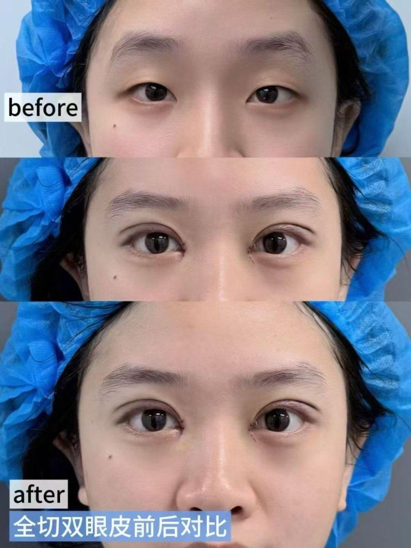 二、假体隆胸的副作用与后遗症