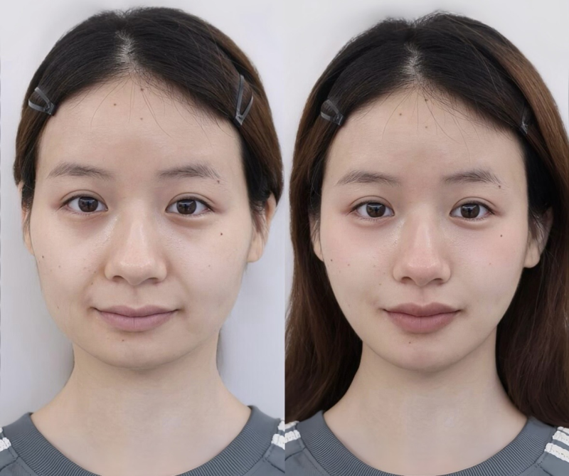 隆鼻多久可以重新修复？6类修复场景 权威整理不同修复间隔指南