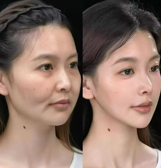 三、紧急并发症修复的间隔时间