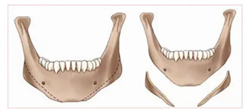 三、微创不开刀祛眼袋方案