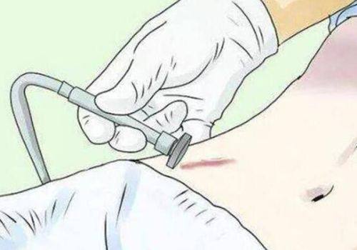 二、手术类长效祛眼袋方案：眶隔释放祛眼袋