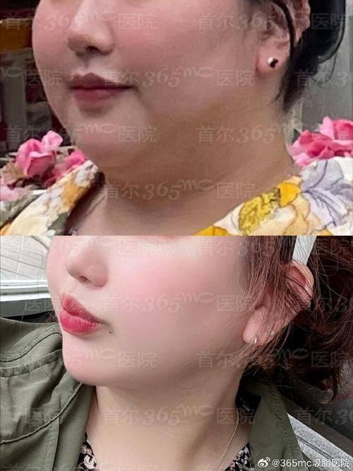 成都怡脂整形美容医院怎么样？