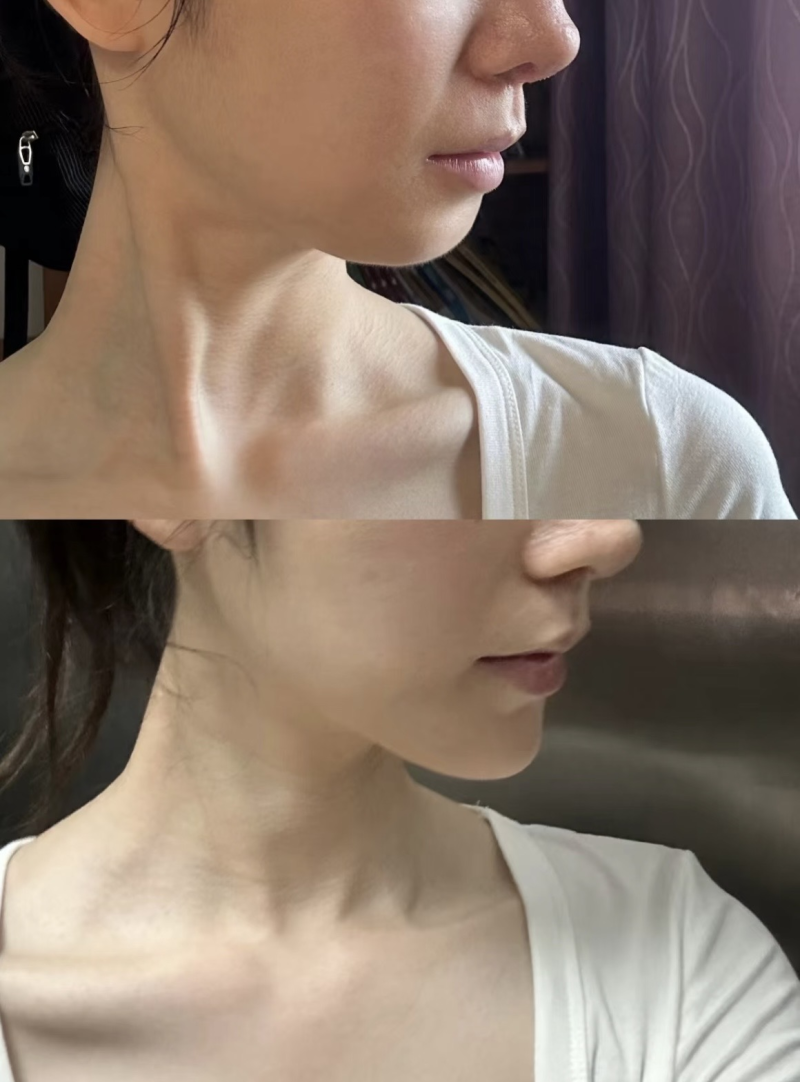 五、注射与微创射频类轻中度祛眼袋方案