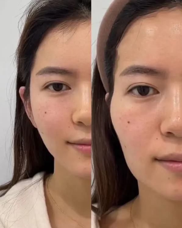 四、蜂蜜涂在眼睛上可以去眼袋吗