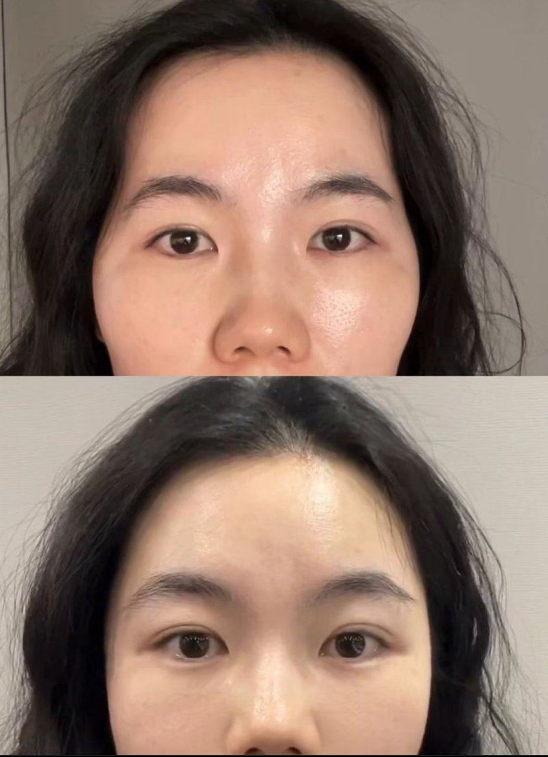 二、双眼皮手术的禁忌人群