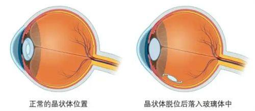 四、激光祛疤的关键注意事项