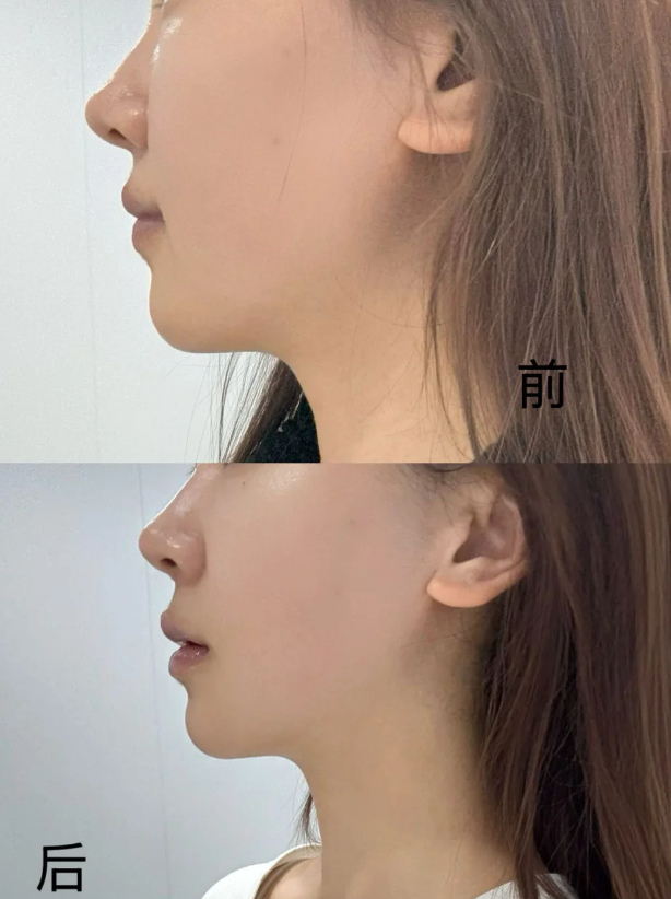 三、补针时的间隔时长要求