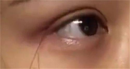 四、超肋（异体假体）隆鼻专属后遗症