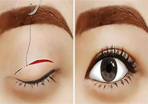 广州美贝尔整形医院价格表：