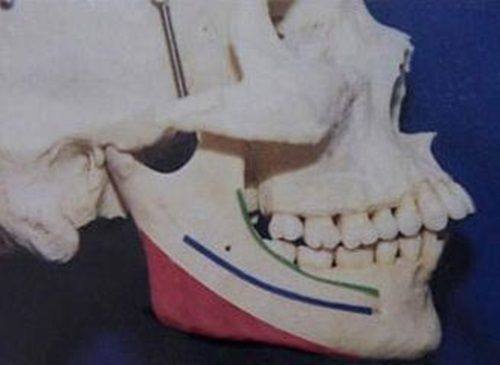 二、影响割双眼皮修复周期的核心因素